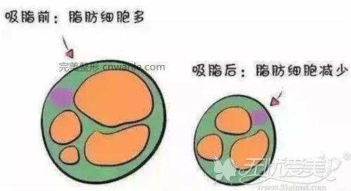 吸脂手術(shù)的部位脂肪量會減少