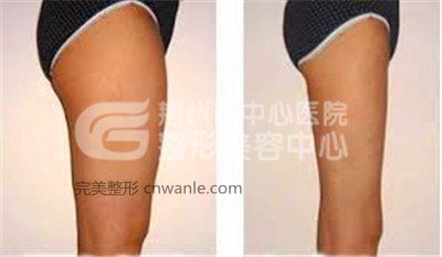 大腿做<a href='/tag_xizhijianfei25.html'>吸脂減肥</a>會反彈么？