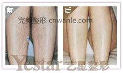 成都藝星激光脫腿毛會(huì)痛嗎