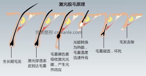 冰點無痛 脫毛儀脫毛原理
