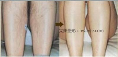 冰點脫毛幾個月會長出來