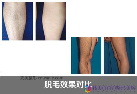 冰點脫毛優(yōu)勢是什么 冰點脫毛優(yōu)勢是什么