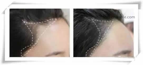 半永久紋發(fā)際線案例對比