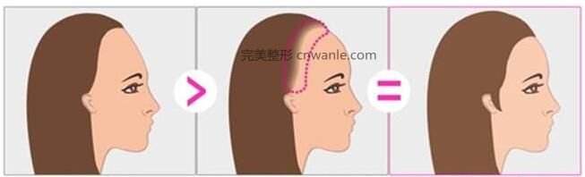 紋發(fā)際線效果