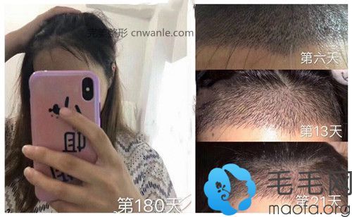 種植發(fā)際線的真實(shí)效果圖