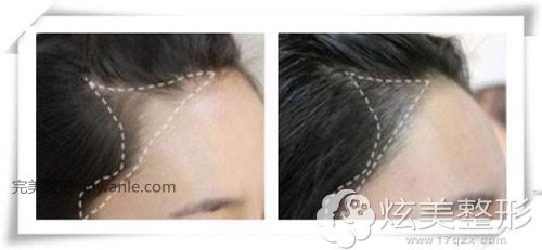 半紋發(fā)際線 半紋發(fā)際線