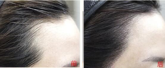 <a href='/tag_banyongjiu.html'>半永久</a>紋發(fā)際線