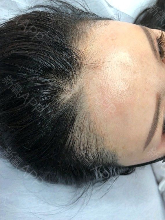 半永久紋發(fā)際線