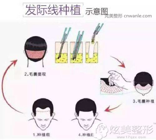 發(fā)際線移植手術(shù)原理 <a href='/tag_fajixianyizhi.html'>發(fā)際線移植</a>手術(shù)原理