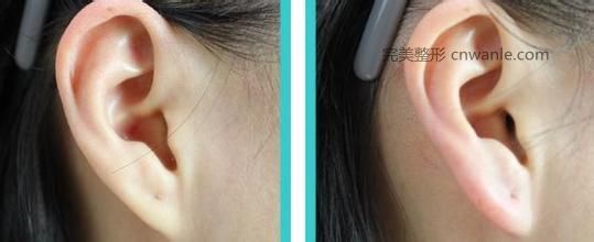 玻尿酸豐耳垂后應(yīng)注意什么問題