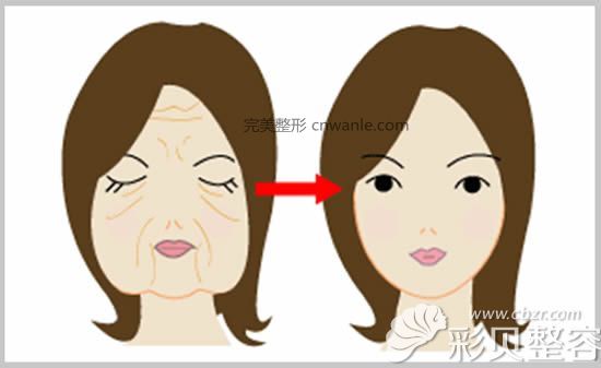 做電波拉皮除皺前后對比效果