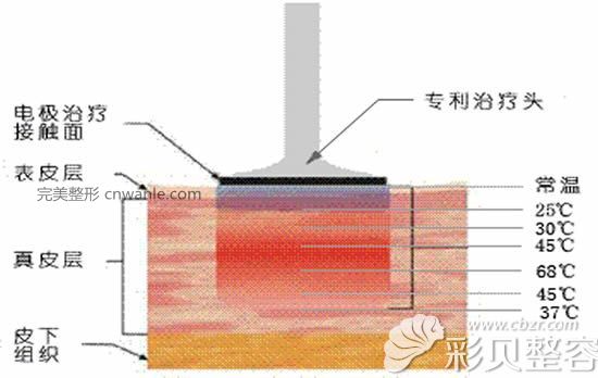 電波拉皮除皺作用原理