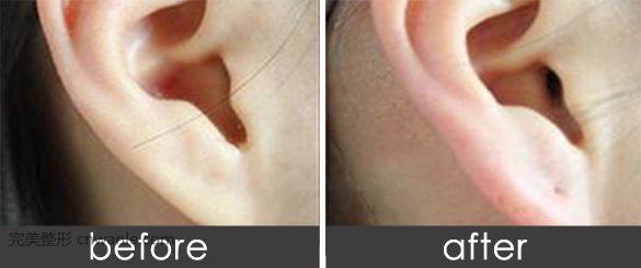 玻尿酸豐耳垂有哪些優(yōu)勢(shì)