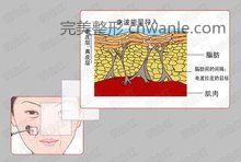 電波拉皮原理圖3 電波拉皮原理圖3