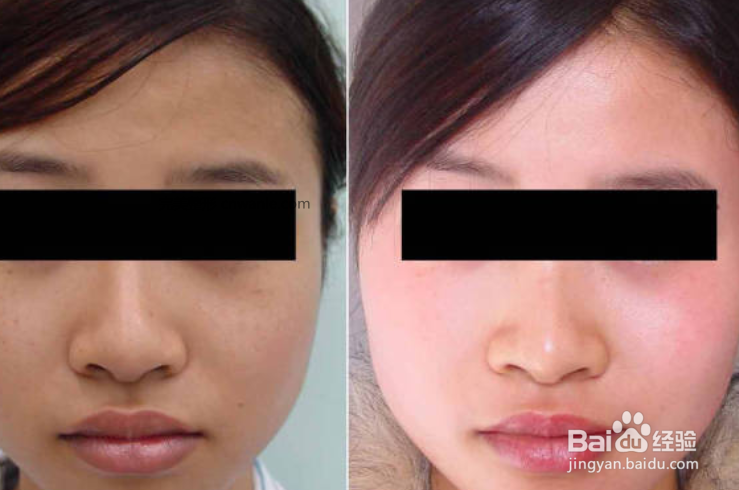 什么是PRT電波拉皮，電波拉皮多少錢一次？