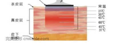 什么是PRT電波拉皮，電波拉皮多少錢一次？