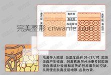 電波拉皮原理圖4 電波拉皮原理圖4