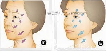 長春哪家醫(yī)院做<a href='/tag_lapichuzhou10.html'>拉皮除皺</a>術好