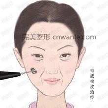 電波拉皮原理圖2 電波拉皮原理圖2