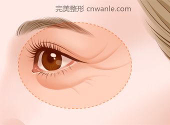 電波拉皮有什么樣的效果？