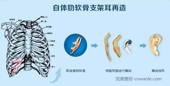 耳畸形_耳再造_肋軟骨造耳_中整協(xié)耳再造救助修復(fù)基地