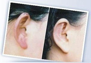 <a href='/tag_waierzaizao.html'>外耳再造</a>