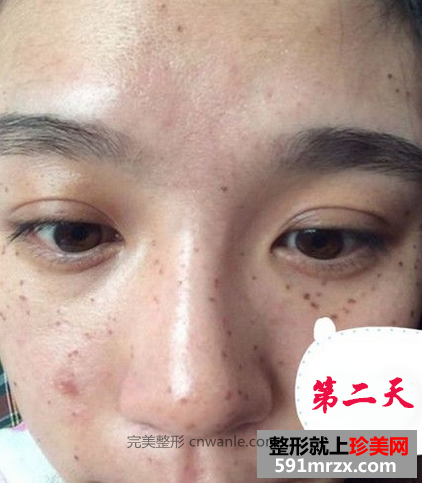 激光去斑效果如何 激光祛斑前后對比圖
