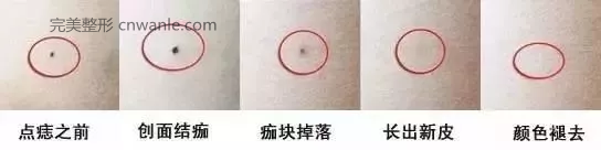 杭州激光祛痣效果如何？