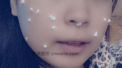 激光去痣之敷麻藥