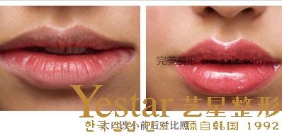 大口改小整形手術(shù)前后對比圖