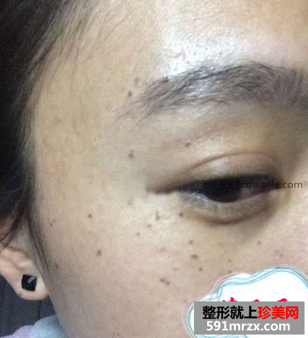 激光去斑效果如何 激光祛斑前后對比圖