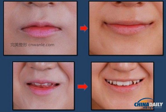 近幾個(gè)月來(lái)，一種被稱為“Smile Lipt”的嘴角<a href='/tag_zhengrong3.html'>整容</a>手術(shù)在韓國(guó)非常風(fēng)靡。該手術(shù)將嘴角切開(kāi)再縫合，重新調(diào)整上下顎的角度，使得嘴部的線條更柔和。