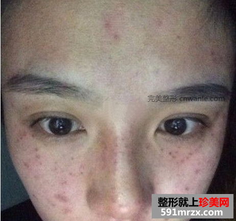 激光去斑效果如何 激光祛斑前后對比圖