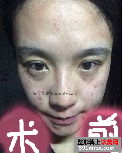 <a href='/tag_jiguangquban52.html'>激光去斑</a>效果如何 激光祛斑<a href='/tag_qianhouduibi.html'>前后對比</a>圖
