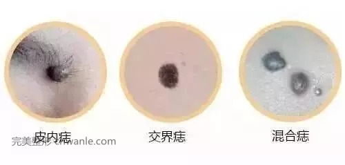 杭州激光祛痣效果如何？