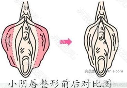 小<a href='/tag_yinchunzhengxing2.html'>陰唇整形</a>
