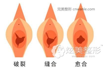 處女膜修復(fù)手術(shù)原理