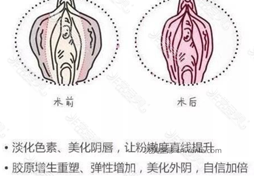 陰唇漂紅有后遺癥嗎