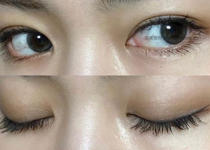 貴陽做<a href='/tag_shuangyanpikaiyan.html'>雙眼皮開眼角</a>|割雙眼皮一定要開眼角嗎？