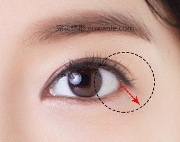 開內眥手術