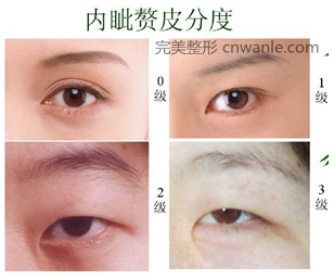 內(nèi)眥贅皮
