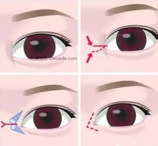 怎么判斷需不需要開眼角？