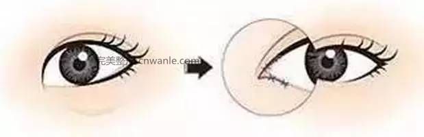 怎么判斷需不需要開眼角？