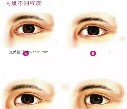 怎么判斷需不需要開眼角？