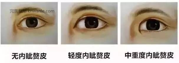 怎么判斷需不需要開眼角？