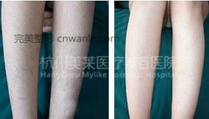 冰點(diǎn)脫毛對(duì)比圖