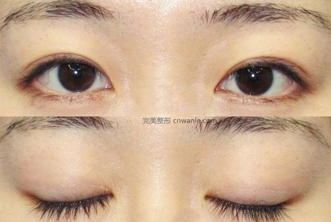 貴陽<a href='/tag_zuoshuangyanpi17.html'>做雙眼皮</a>開眼角|割雙眼皮一定要開眼角嗎？