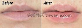 自體脂肪豐純效果前后對比