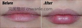 <a href='/tag_zhushefengchun4.html'>注射豐唇</a>效果<a href='/tag_qianhouduibi.html'>前后對比</a>