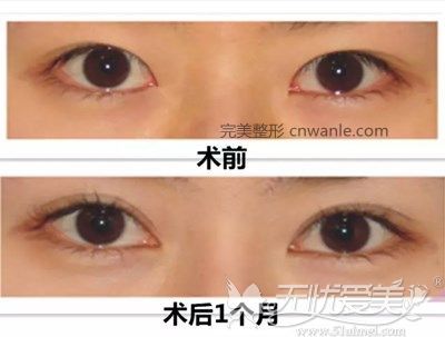 內(nèi)眥贅皮矯正手術(shù)1個(gè)月的對(duì)比圖